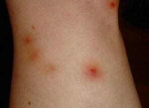 Cockroach Bites: Signs and Remedies | Panther Pest Control