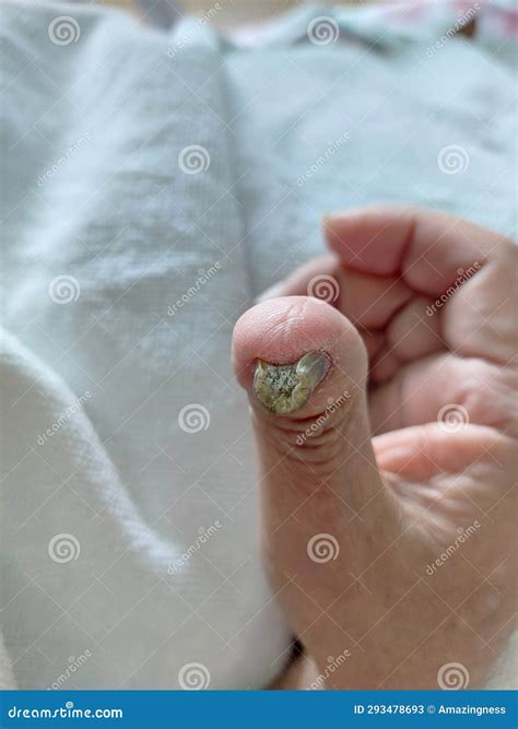 Fungal Nail Infections on Right Thumb. Stock Image - Image of