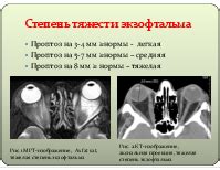 Лучевые методы диагностики эндокринной офтальмопатии. Этиология и ...