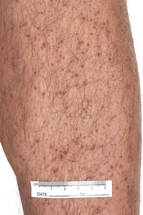 Mild Petechiae Legs