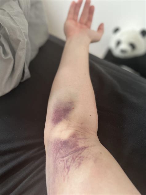 Day after my 50th blood donation : r/mildlyinfuriating