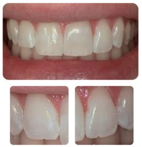 ICON Resin Infiltration | Encore Family Dentistry | Marietta-East Cobb