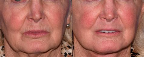 Skin Rejuvenation photos | Beverly Hills, CA. | Patient 16687