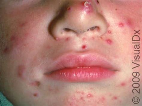 Acne Cyst Nose