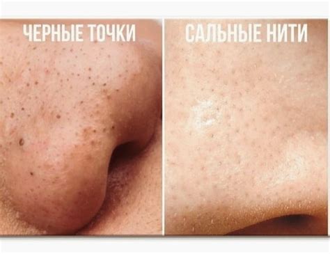 Do not confuse black dots with sebaceous threads! What is their ...