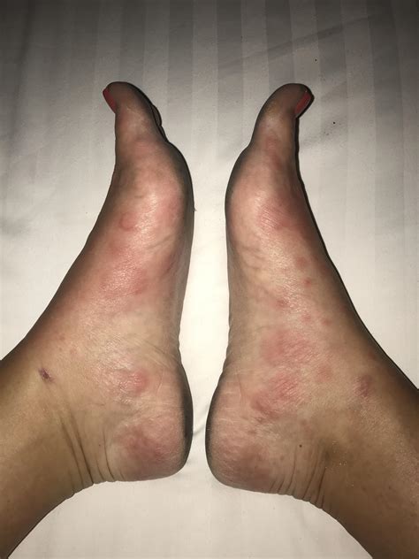 Hives On Feet