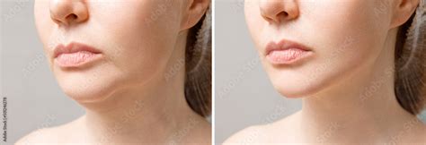 Female double chin before and after correction. Correction of the chin ...
