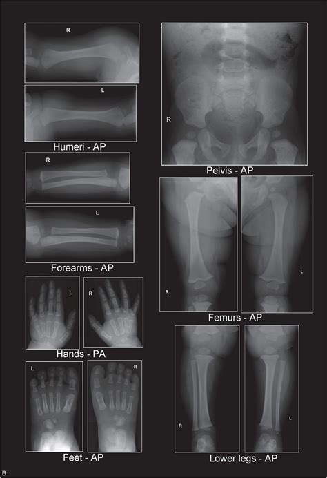 Quality assurance and radiographic skeletal survey standards ...