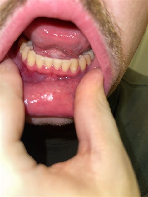 how long for gingivitis to go away