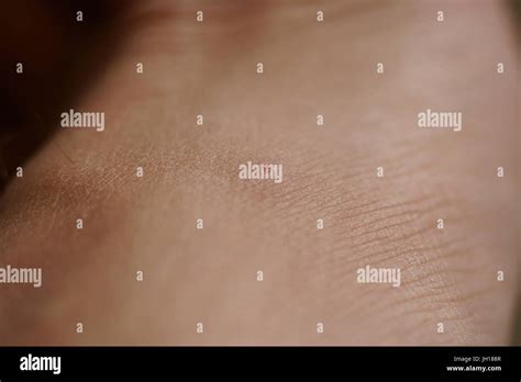 Black fly bite, skin, people, São Paulo, Brazil Stock Photo - Alamy