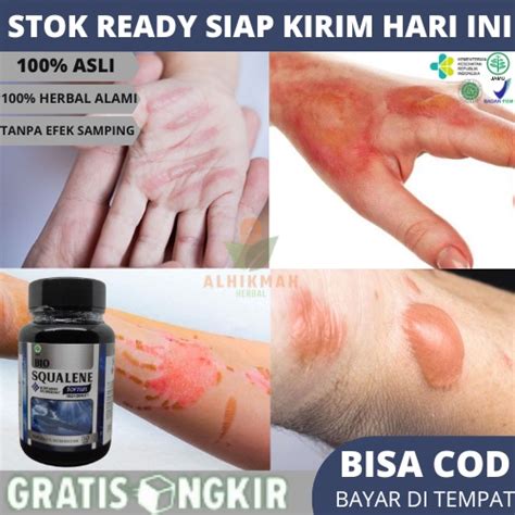 Jual Obat Luka Bakar, Obat Pengering Luka Bakar, Obat Mempercepat ...