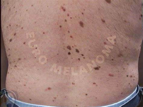 Benign Lesions - Moles - Euromelanoma