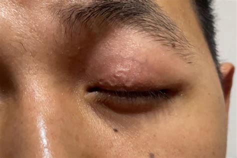 Doctors' horrifying discovery after twitching in man's eye