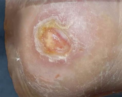 Fersendekubitus - Druckgeschwür an der Ferse. Prophylaxe, Therapie