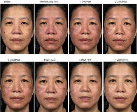 Microneedle Therapy System 2-MicroSkin Beauty | Microneedling, Facial ...