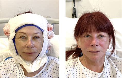 Deep Plane Facelift Surgery Recovery London UK | Rajiv Grover
