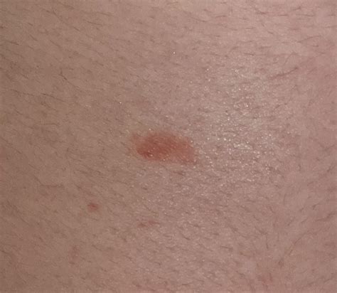 an itchy red spot on the skin : r/DermatologyQuestions