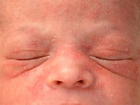 Erythema Toxicum Neonatorum Medsphere Erythema Toxicum Information