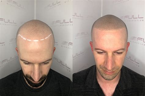 Seattle, WA - FULL Micropigmentation