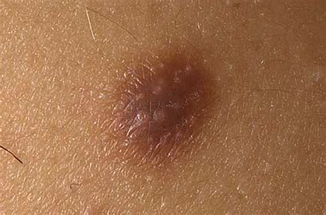 Dermatofibroma - Treatment, Pictures, Removal, Causes