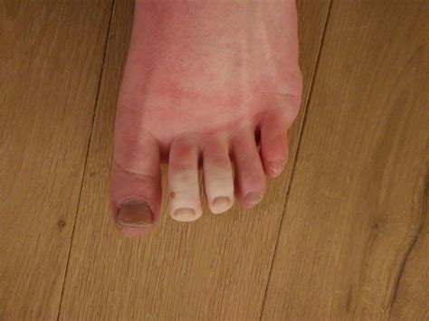 Raynaud's symptoms on my toes : r/mildlyinteresting