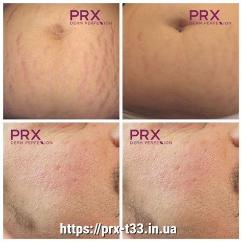 Пілінг PRX-T33 до і після - prx-t33.in.ua