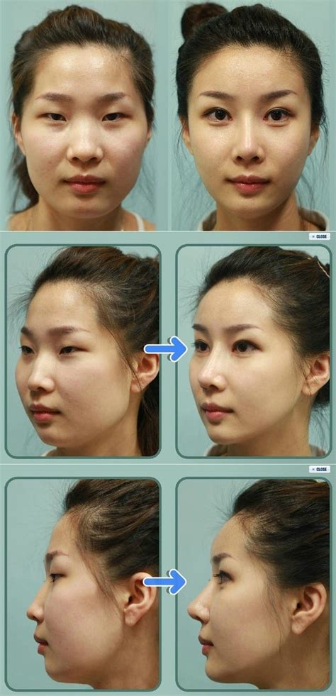 Before & After Korea Plastic Surgery - The Odds