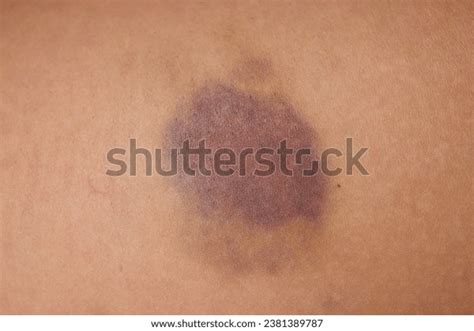 impact abrasion human skin   images pictures shutterstock