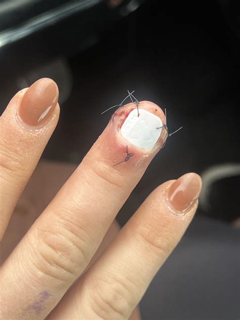 6 days Post finger/nail bed surgery : r/woundcare