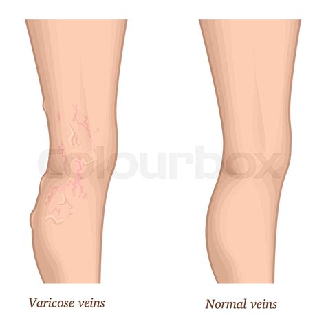 Illustration of varicose veins | Stock vector | Colourbox