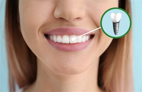 Зъбни импланти за възвръщане на усмивката - Marinova Dental Clinic