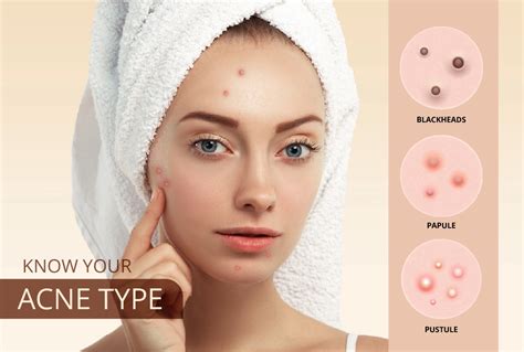acne types  acne  treatment methods