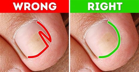 How to Cut An Ingrown Toenail: Expert Home Trimming Guide – Nghia ...