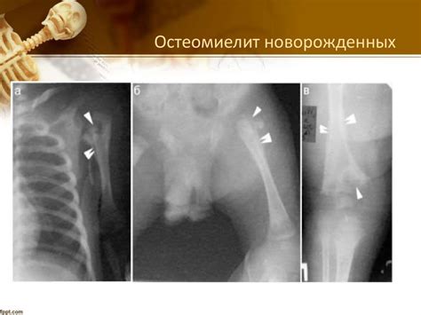 Рентгенодиагностика остеомиелита - презентация онлайн