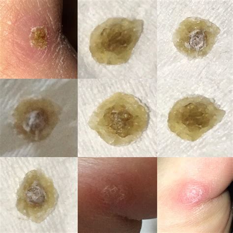 Plantar Wart On Side Of Toe at Rose Anderson blog