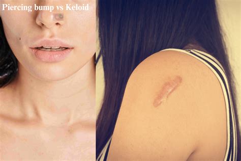 Piercing Bump vs Keloid: Differences and Treatment Options