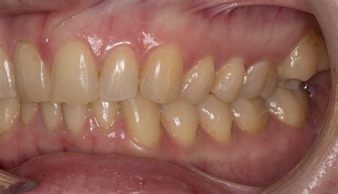 buccal crossbite scissor bite