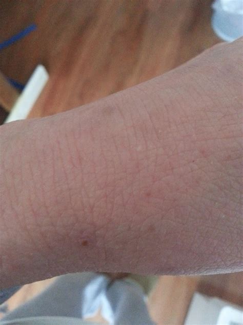 Topical Steroid Withdrawal Journey