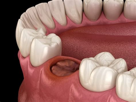 Avoid A Dry Socket | Tooth Extraction | Partha Dental Clinic