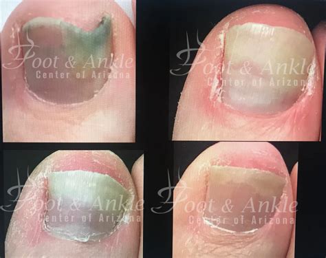 Toenail Fungus Prevention and Treatment - Foot & Ankle Center of Arizona