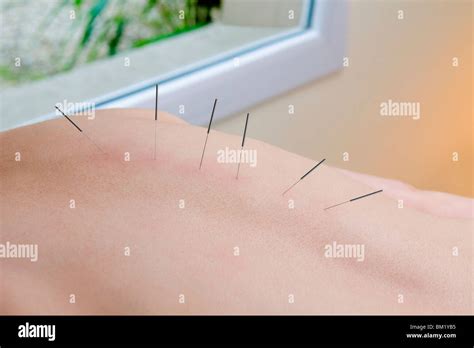 Acupuncture needles on a person's back Stock Photo - Alamy