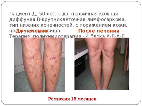 Лимфомы кожи
