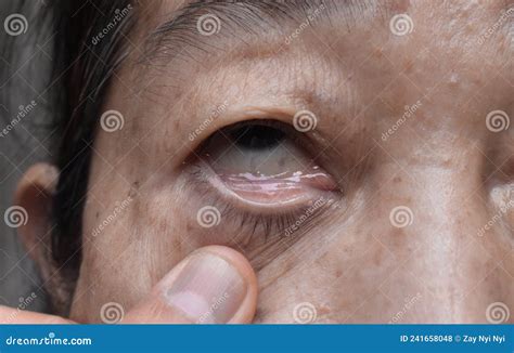 Anemia Eyes