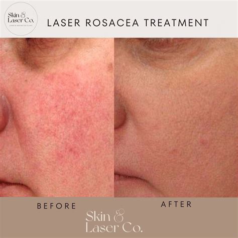 Laser Treatment for Rosacea - Skin Laser Co