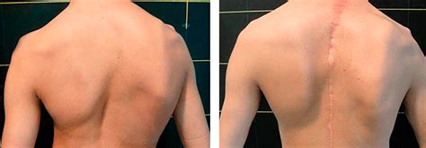 Escoliose Leve Antes E Depois - Como realizar tratamento da Escoliose através do Método Pilates