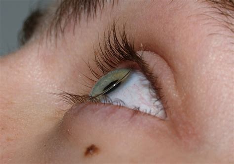 rigid gas-permeable contact lens on eye | Contact lenses, Gas permeable ...