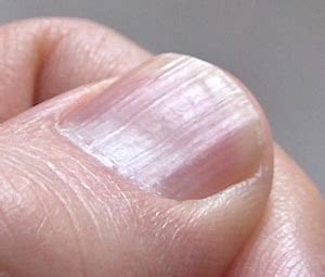 Lines on Nails? Vitamin Deficiency May Be the Culprit | Healthcare-Online