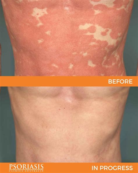 Psoriasis before & afters - Dermatology Clinics Australia