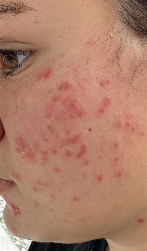 Weird rash on teens face : r/skin