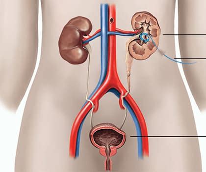 Percutaneous Nephrostomy | Vascular Interventions